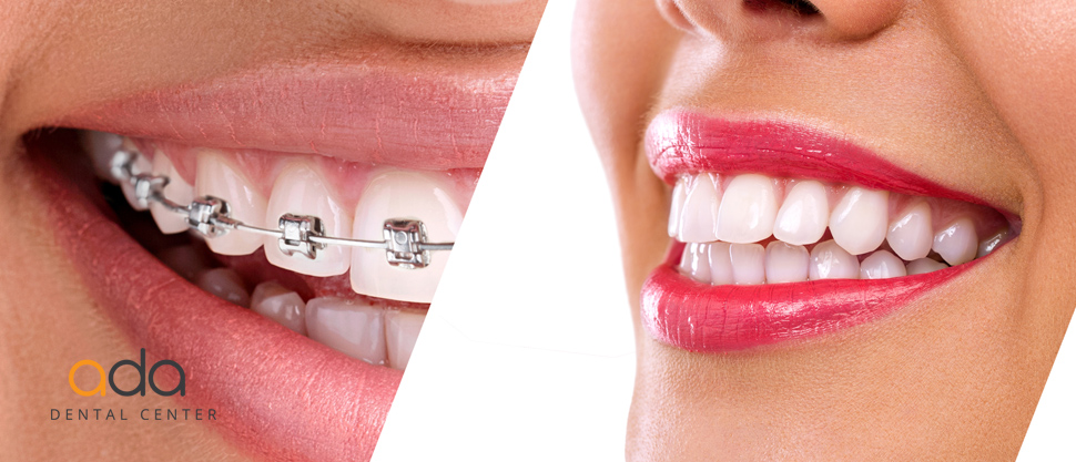 Mediate Advise mild Alimentația corectă în cazul aplicării aparatului dentar - Ada Dental Center